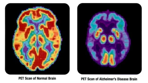 PET Scan