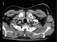 Axial view shows enlarged axillary lymph node.