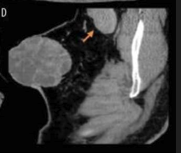 Sagittal view confirms lymph node involvement.