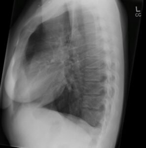 Chest Xray