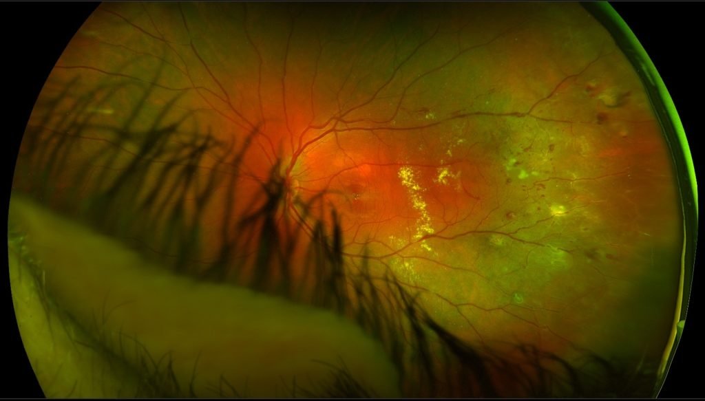 Left retinal fundoscopy